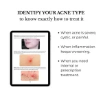 Clinical acne identification chart for grading severity and medical intervention needs.