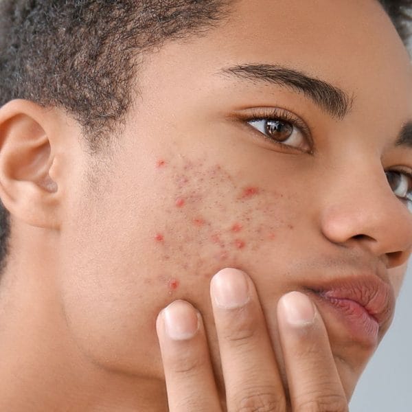 acne website pics 26