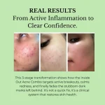 Real Client Transformation: Inside Out Acne Combo