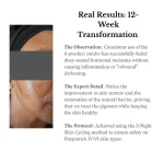 Before and after 12-week progress of melasma treatment on South African skin