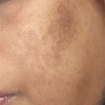 Clinical close-up of melasma and hyperpigmentation on South African skin