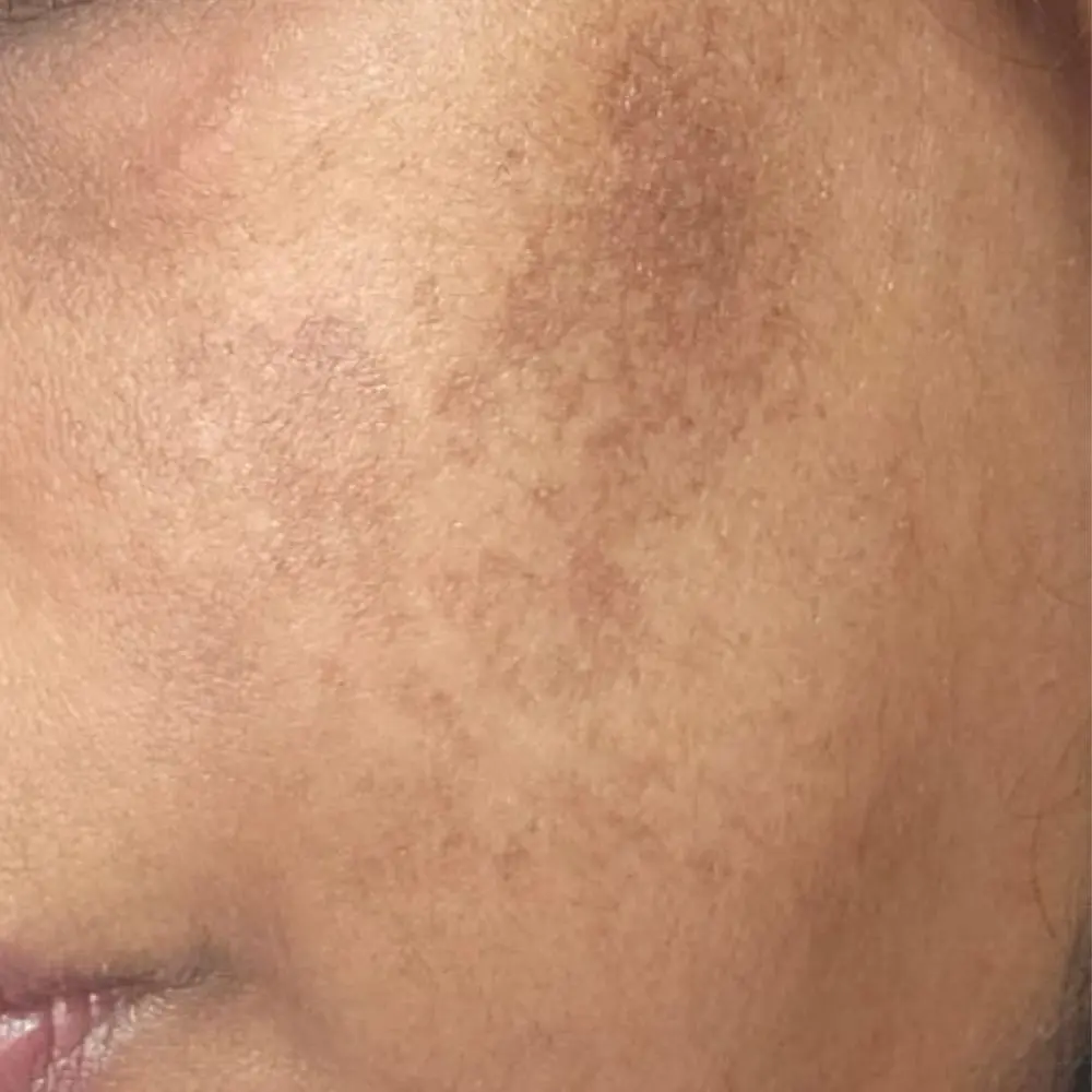 Clinical close-up of melasma and hyperpigmentation on South African skin