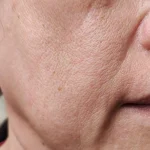 Clinical macro shot of photo-aged skin texture and solar-induced fine lines on South African skin types.