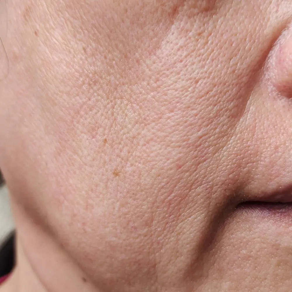 Clinical macro shot of photo-aged skin texture and solar-induced fine lines on South African skin types.