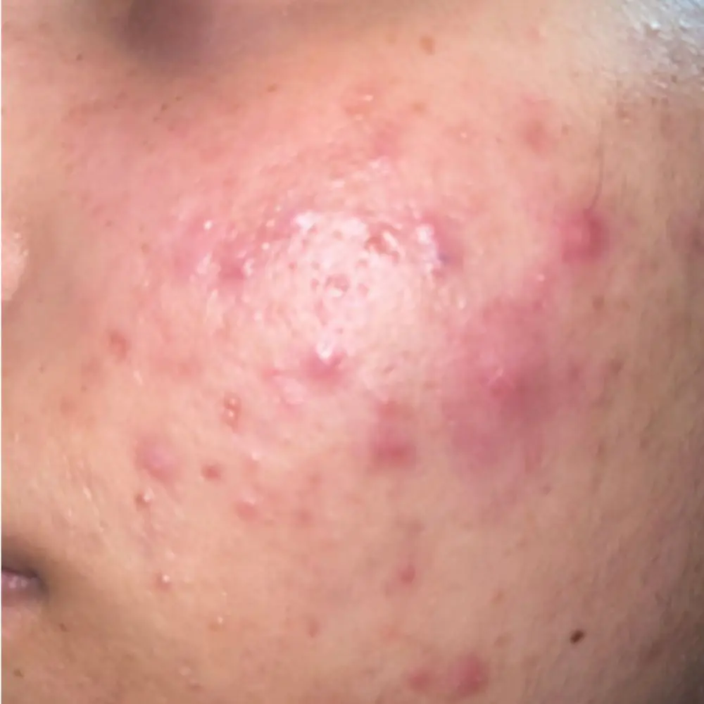 Clinical macro shot of active acne lesions and congested pores on South African skin.