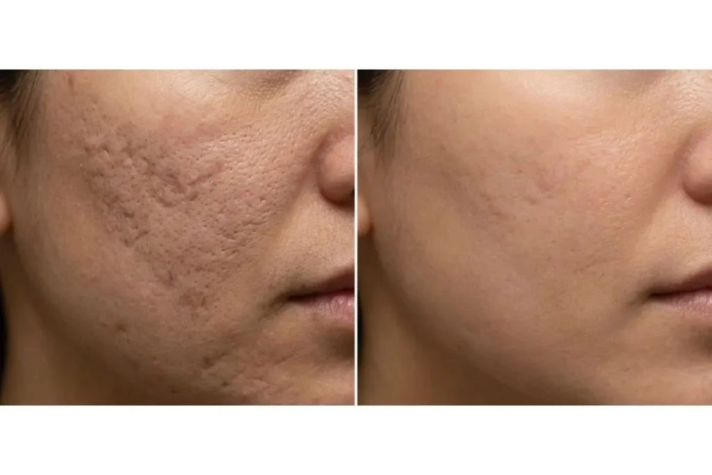 The Ultimate Microneedling Guide 2026 Benefits, Needle Sizes & Safety, before and after ex