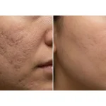 The Ultimate Microneedling Guide 2026 Benefits, Needle Sizes & Safety, before and after ex